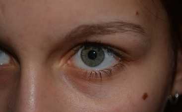 Проверяйте родинки: чего стоит бояться