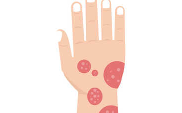 Лишай у ребенка: как вылечить