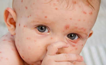 Как лечить ветрянку у детей?