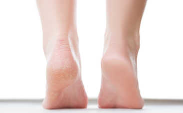 Почему на пятках появляются трещины?