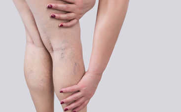 ТОП-6 разновидностей отеков ног: а какие беспокоят вас?