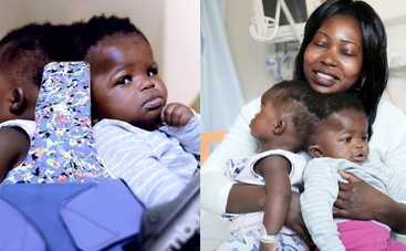 Впервые в истории врачи разделили сиамских близнецов со сросшимися сосудами мозга