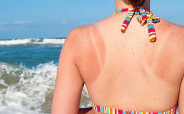 Как быстро избавиться от ожогов: ТОП-4 проверенных совета