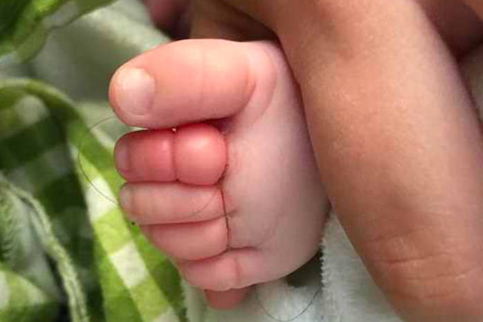 Синдром волосяного жгута: ребенок может потерять палец