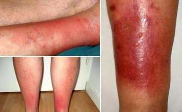 Рожа – огородная болезнь: чем опасна и как ее лечить – советует доктор