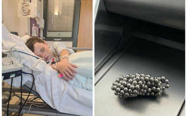 Новая жертва Tik Tok: 9-летний мальчик проглотил магниты для пирсинга