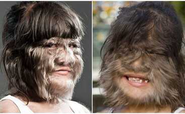 Самая волосатая девочка в мире: как она выглядит сейчас?