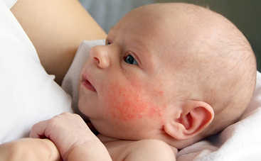 Токсическая эритема новорожденных: опасно ли это – ответ врача