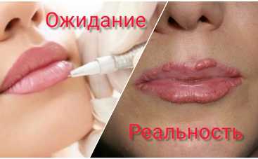 Опасная косметология: побочные эффекты популярных процедур
