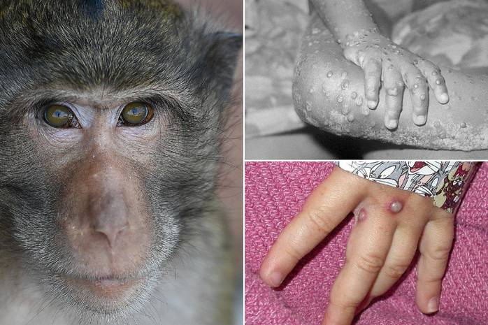 Віспа мавп: чи буде нова пандемія - думка лікарів