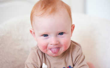 Диатез у ребенка: 3 причины красных щек у малыша