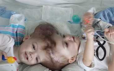 В США разъединили сросшихся головами близнецов (фото)