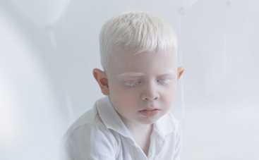 Белые вороны: гипнотизирующая красота детей-альбиносов (фото)