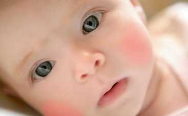 Красные щечки: 5 заповедей против диатеза