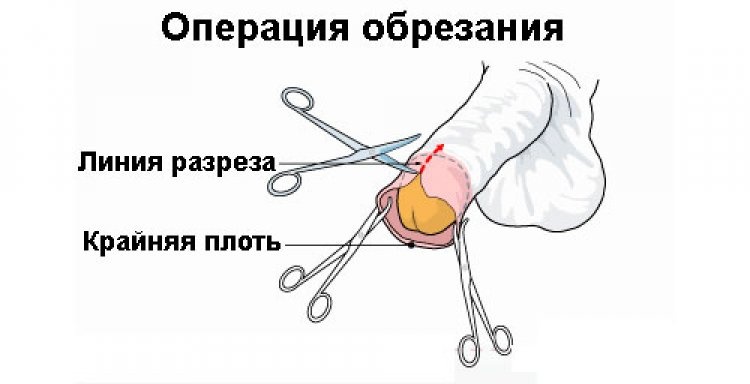 operatsiya_obrezaniya_750x384