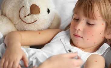 В Киеве вспышка кори: на 21 день объявлены специальные мероприятия