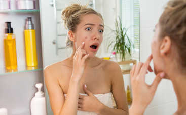 Подростковые прыщи: как ухаживать за кожей, чтобы не сделать еще хуже