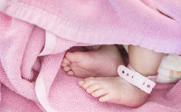 Редкий случай: в Индонезии родилась девочка с двумя лицами (фото)