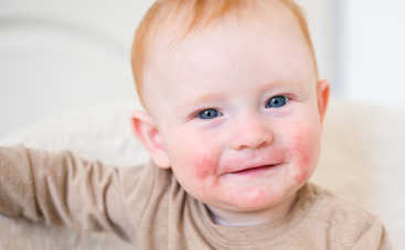 Экссудативный диатез у детей: симптомы, причины и лечение